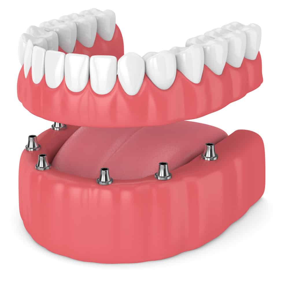Implant retained dentures Houston