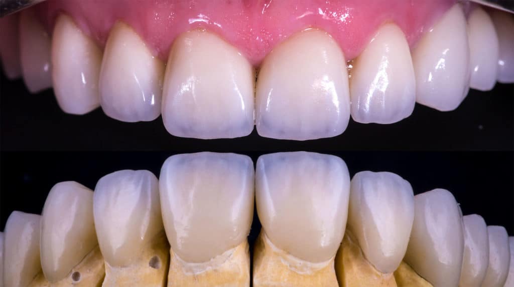 Full mouth reconstruction by Houston Prosthodontist