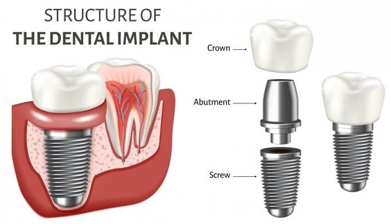 Structure of a Dental Implant